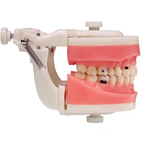 Dentes Cariados (MDT044) - Pronew/Prodens