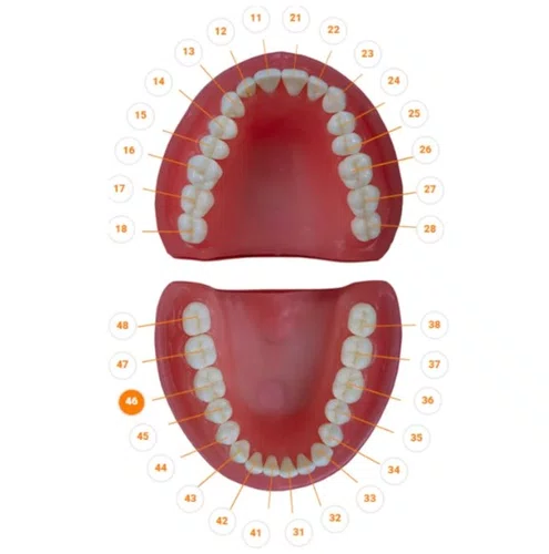Dente I Oclusal Cariado 46.6 - Prodens