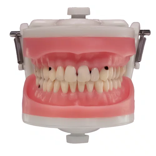 Jogo de Dentes Cariados (MDT074/4092) - Pronew/Prodens