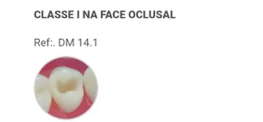 Dente Dm 14.1 Classe I Na Face Oclusal - Prodens/Pronew