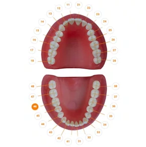 Dente I Oclusal Cariado 46.6 - Prodens