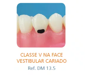 DENTE V NA FACE VESTIBULAR CARIADO 13.5 - PRODENS