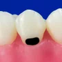 DENTE V NA FACE VESTIBULAR CARIADO 13.5 - PRODENS