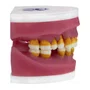 Manequim Refil de Cirurgia com Dente de Perio (AC025) - Pronew/Prodens